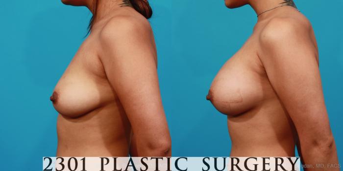 Before & After Silicone Implants Case 277 View #2 View in Fort Worth, Plano, & Frisco, Texas