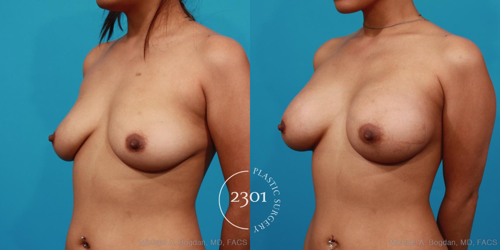 Before & After Silicone Implants Case 277 View #3 View in Fort Worth, Plano, & Frisco, Texas