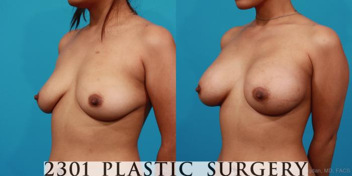 Before & After Silicone Implants Case 277 View #3 View in Fort Worth, Plano, & Frisco, Texas