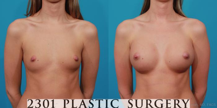 Before & After Breast Augmentation Case 281 View #1 View in Fort Worth, Plano, & Frisco, Texas