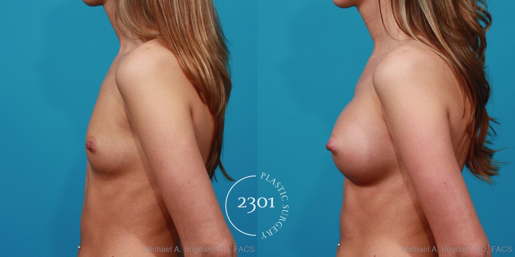 Before & After Silicone Implants Case 281 View #2 View in Fort Worth, Plano, & Frisco, Texas