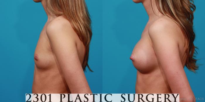 Before & After Silicone Implants Case 281 View #2 View in Fort Worth, Plano, & Frisco, Texas