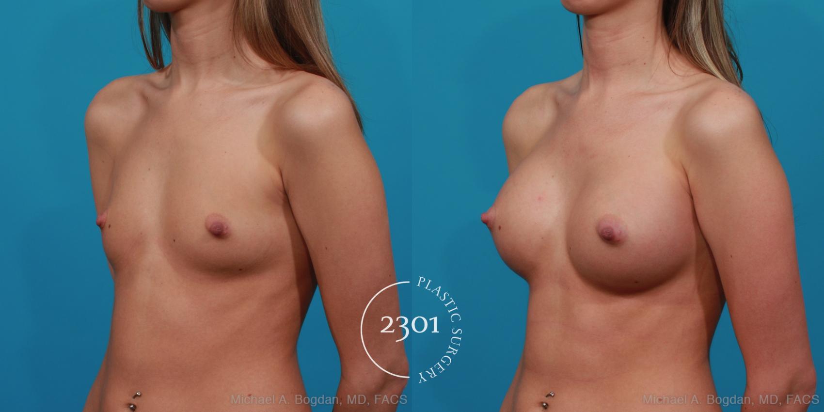 Before & After Silicone Implants Case 281 View #3 View in Fort Worth, Plano, & Frisco, Texas