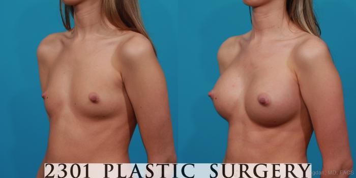 Before & After Silicone Implants Case 281 View #3 View in Fort Worth, Plano, & Frisco, Texas