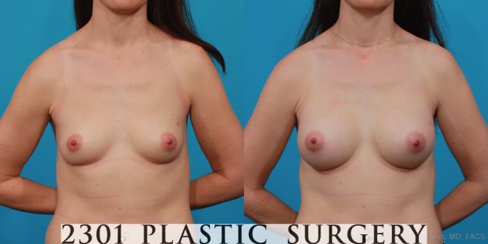 Before & After Silicone Implants Case 285 View #1 View in Fort Worth, Plano, & Frisco, Texas