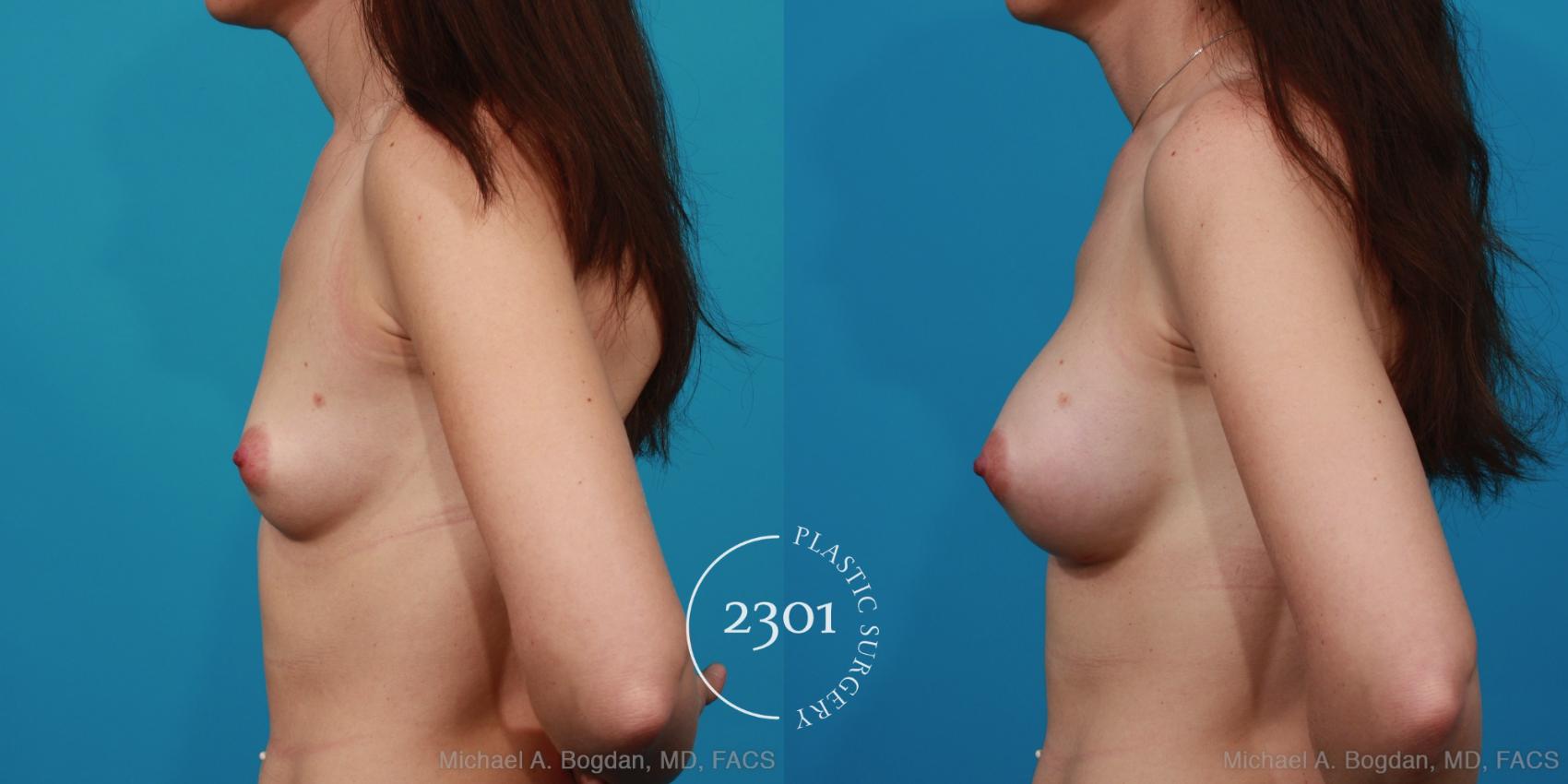 Before & After Silicone Implants Case 285 View #2 View in Fort Worth, Plano, & Frisco, Texas