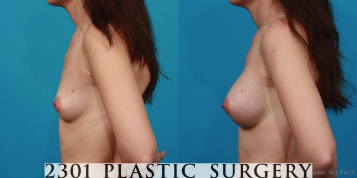 Before & After Silicone Implants Case 285 View #2 View in Fort Worth, Plano, & Frisco, Texas