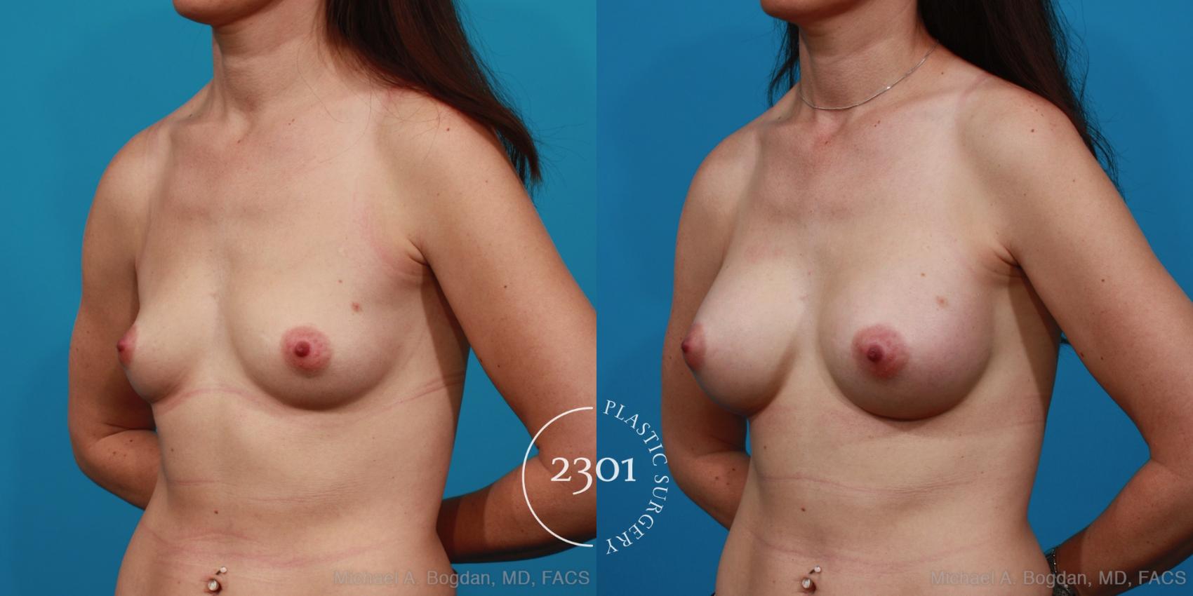 Before & After Silicone Implants Case 285 View #3 View in Fort Worth, Plano, & Frisco, Texas