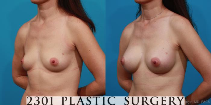 Before & After Silicone Implants Case 285 View #3 View in Fort Worth, Plano, & Frisco, Texas