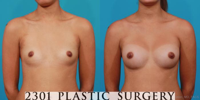 Before & After Silicone Implants Case 287 View #1 View in Fort Worth, Plano, & Frisco, Texas
