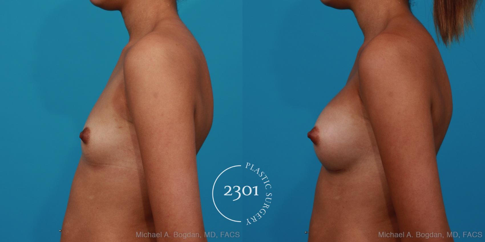 Before & After Silicone Implants Case 287 View #2 View in Fort Worth, Plano, & Frisco, Texas