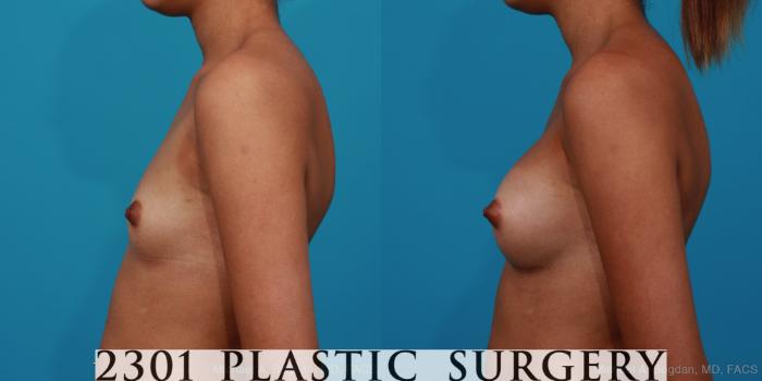 Before & After Silicone Implants Case 287 View #2 View in Fort Worth, Plano, & Frisco, Texas