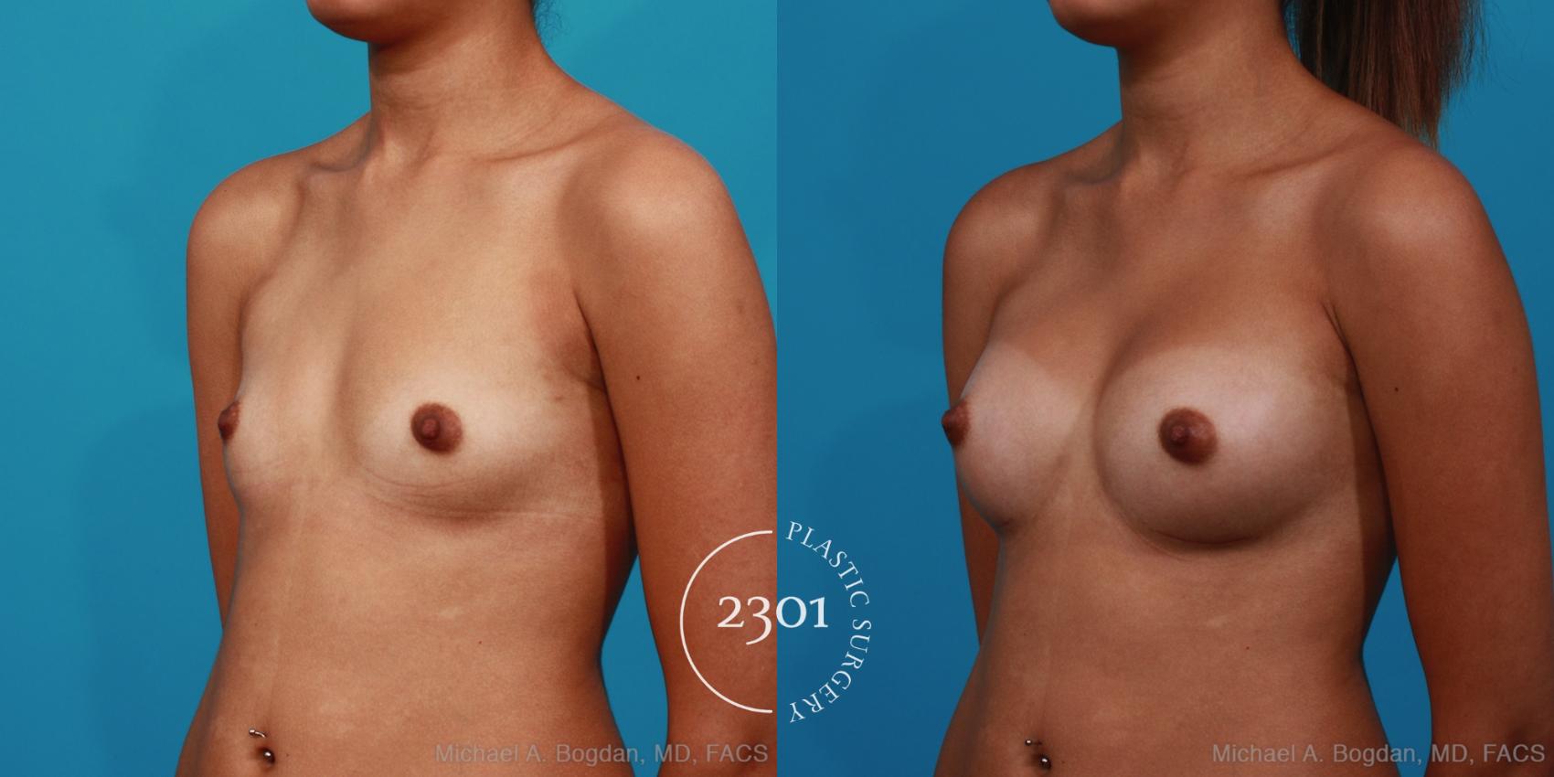 Before & After Silicone Implants Case 287 View #3 View in Fort Worth, Plano, & Frisco, Texas