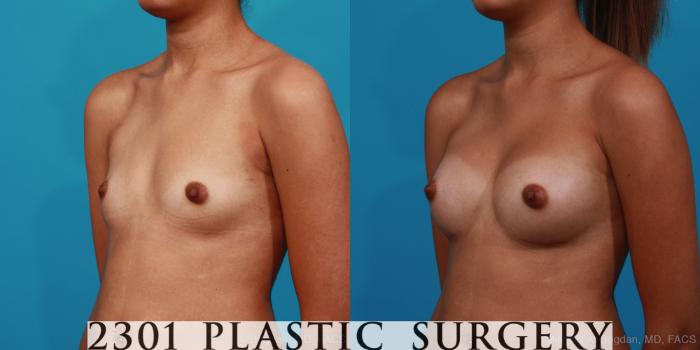Before & After Silicone Implants Case 287 View #3 View in Fort Worth, Plano, & Frisco, Texas