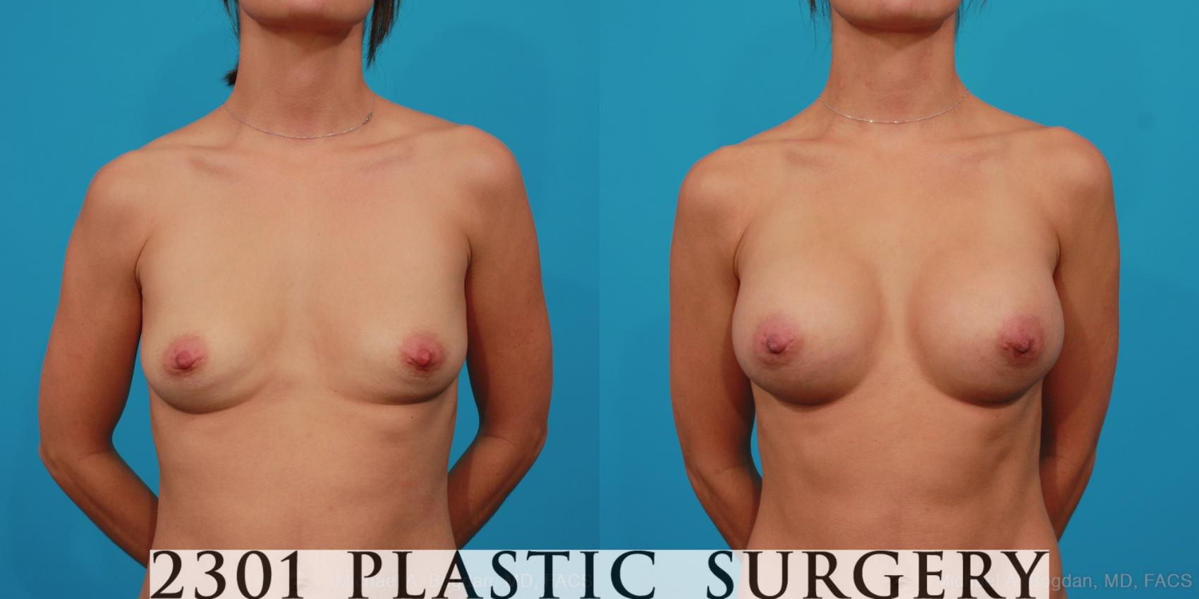 Before & After Silicone Implants Case 288 View #1 View in Fort Worth & Frisco, Texas