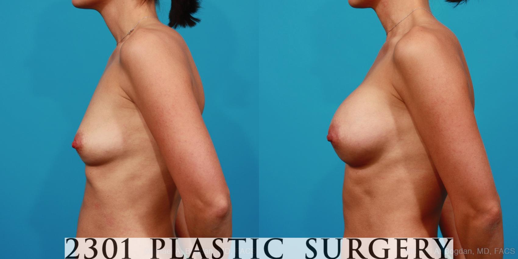 Before & After Silicone Implants Case 288 View #2 View in Fort Worth & Frisco, Texas