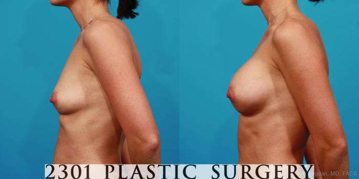 Before & After Silicone Implants Case 288 View #2 View in Fort Worth, Plano, & Frisco, Texas