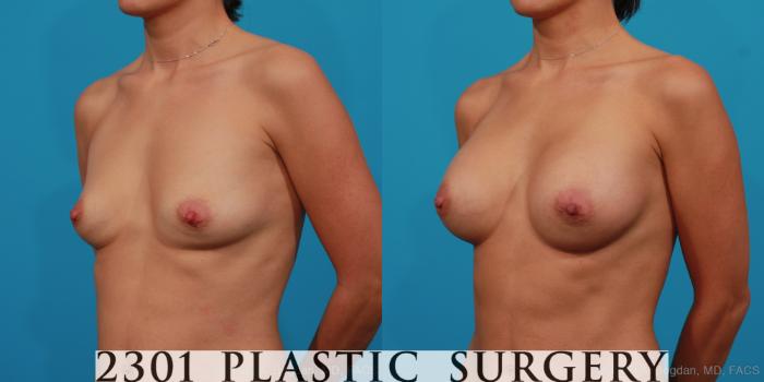 Before & After Silicone Implants Case 288 View #3 View in Fort Worth, Plano, & Frisco, Texas