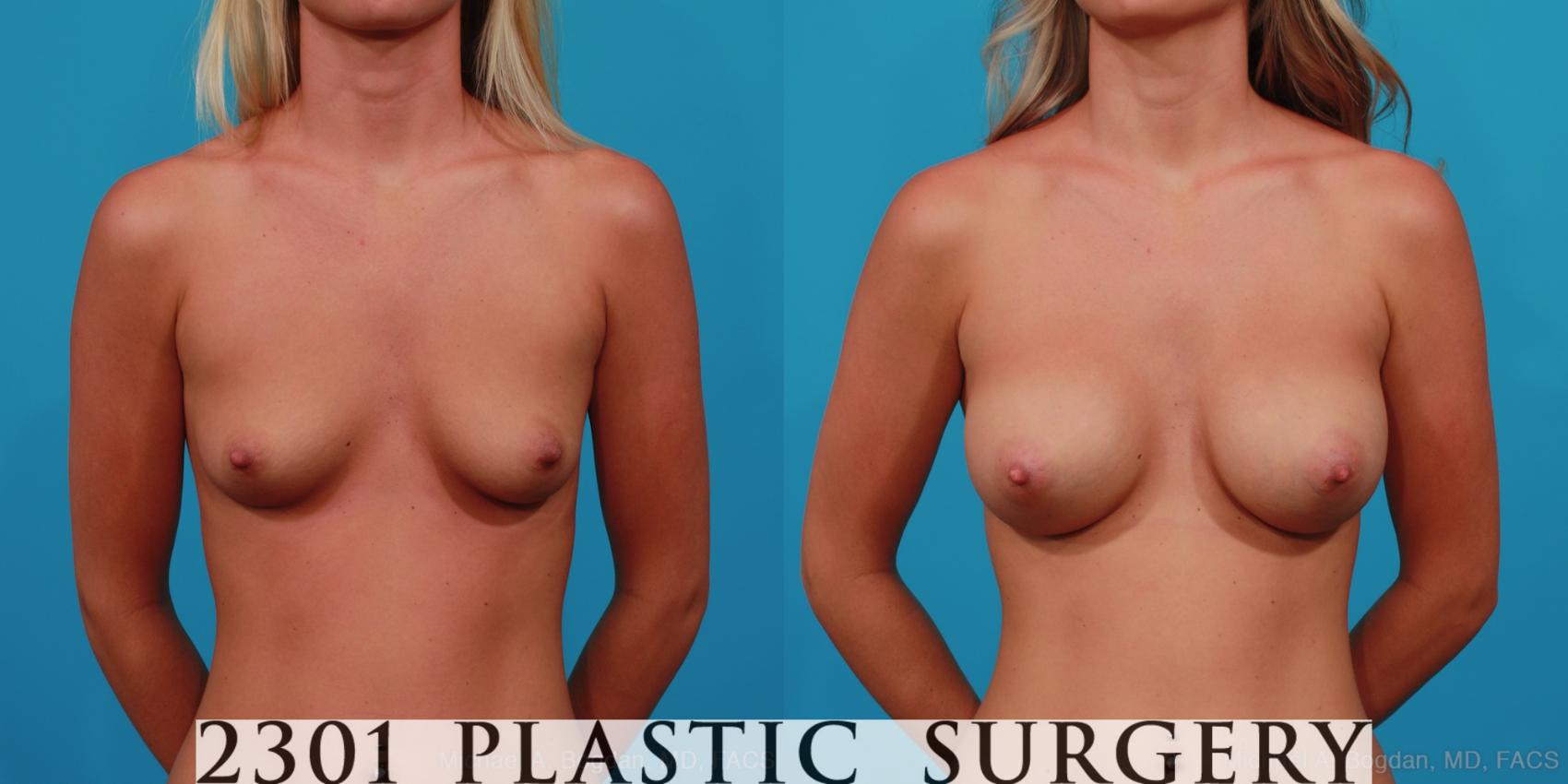 Before & After Silicone Implants Case 298 View #1 View in Fort Worth, Plano, & Frisco, Texas