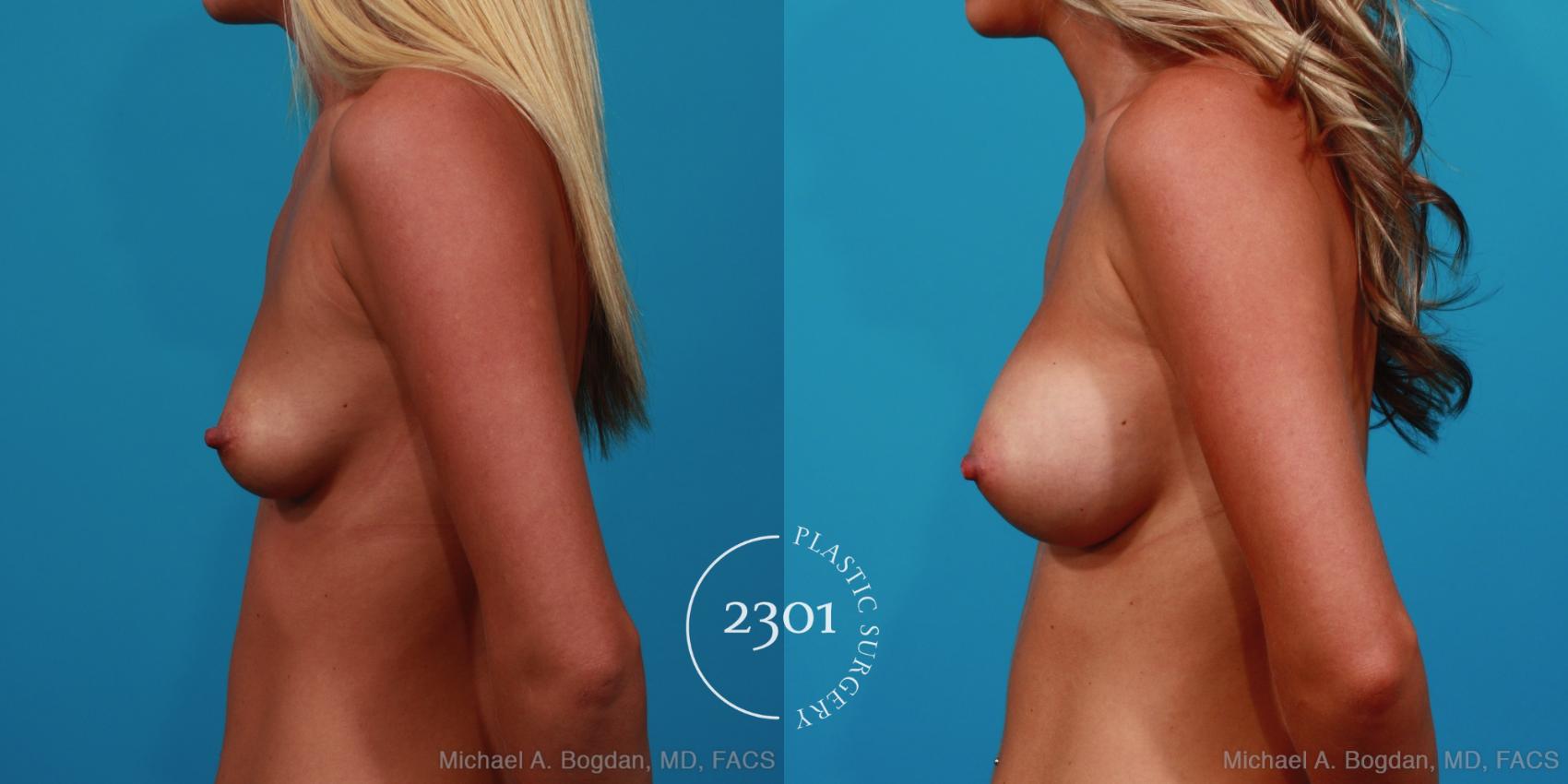 Before & After Silicone Implants Case 298 View #2 View in Fort Worth, Plano, & Frisco, Texas