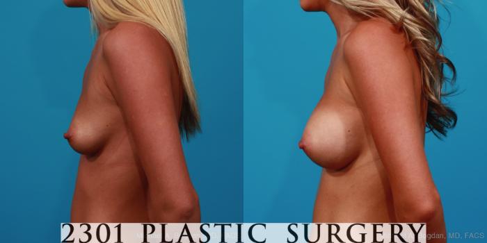 Before & After Breast Augmentation Case 298 View #2 View in Fort Worth, Plano, & Frisco, Texas