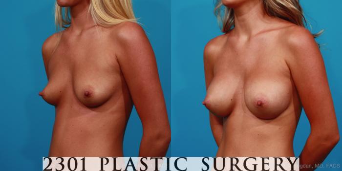 Before & After Breast Augmentation Case 298 View #3 View in Fort Worth, Plano, & Frisco, Texas