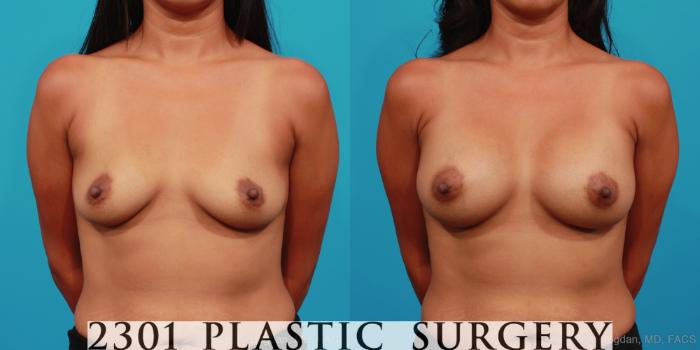 Before & After Silicone Implants Case 306 View #1 View in Fort Worth, Plano, & Frisco, Texas