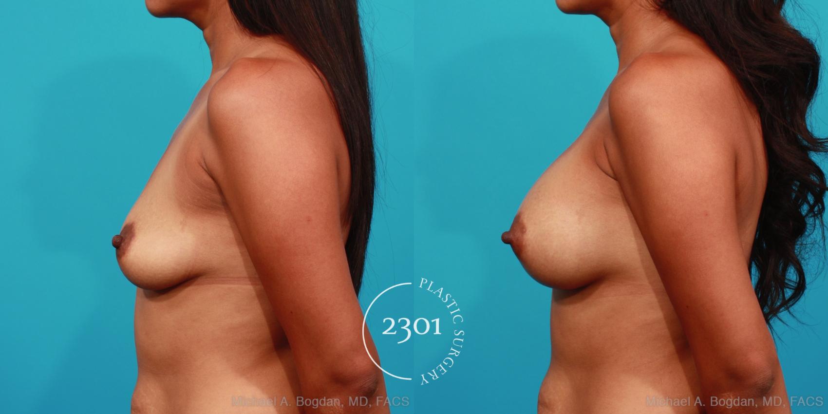 Before & After Silicone Implants Case 306 View #2 View in Fort Worth, Plano, & Frisco, Texas