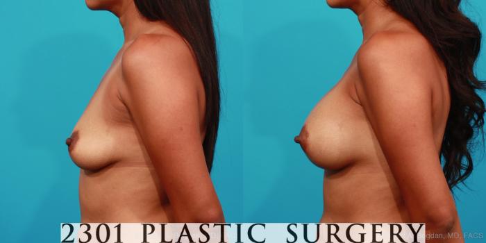Before & After Silicone Implants Case 306 View #2 View in Fort Worth, Plano, & Frisco, Texas