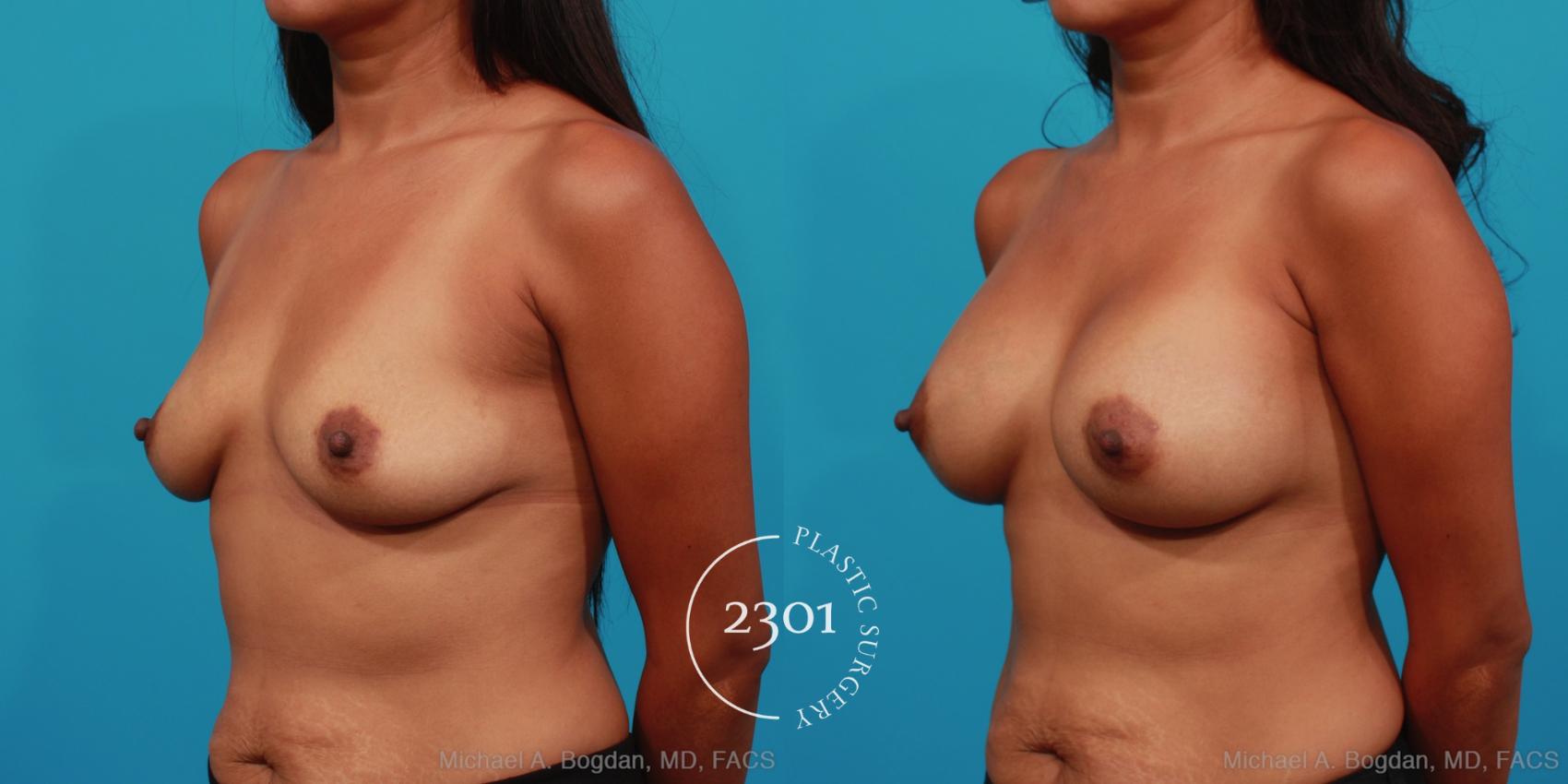 Before & After Silicone Implants Case 306 View #3 View in Fort Worth, Plano, & Frisco, Texas