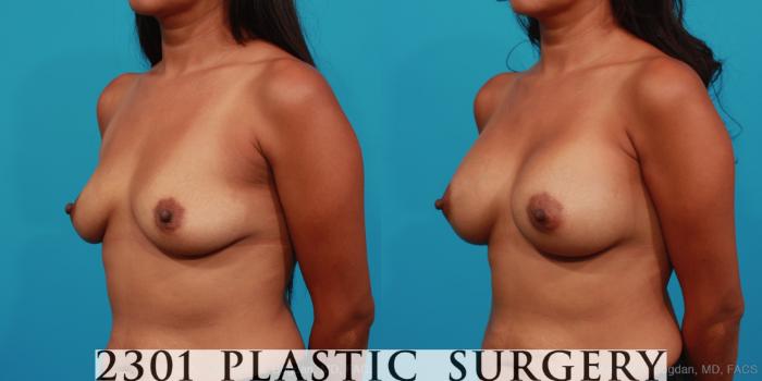 Before & After Breast Augmentation Case 306 View #3 View in Fort Worth, Plano, & Frisco, Texas