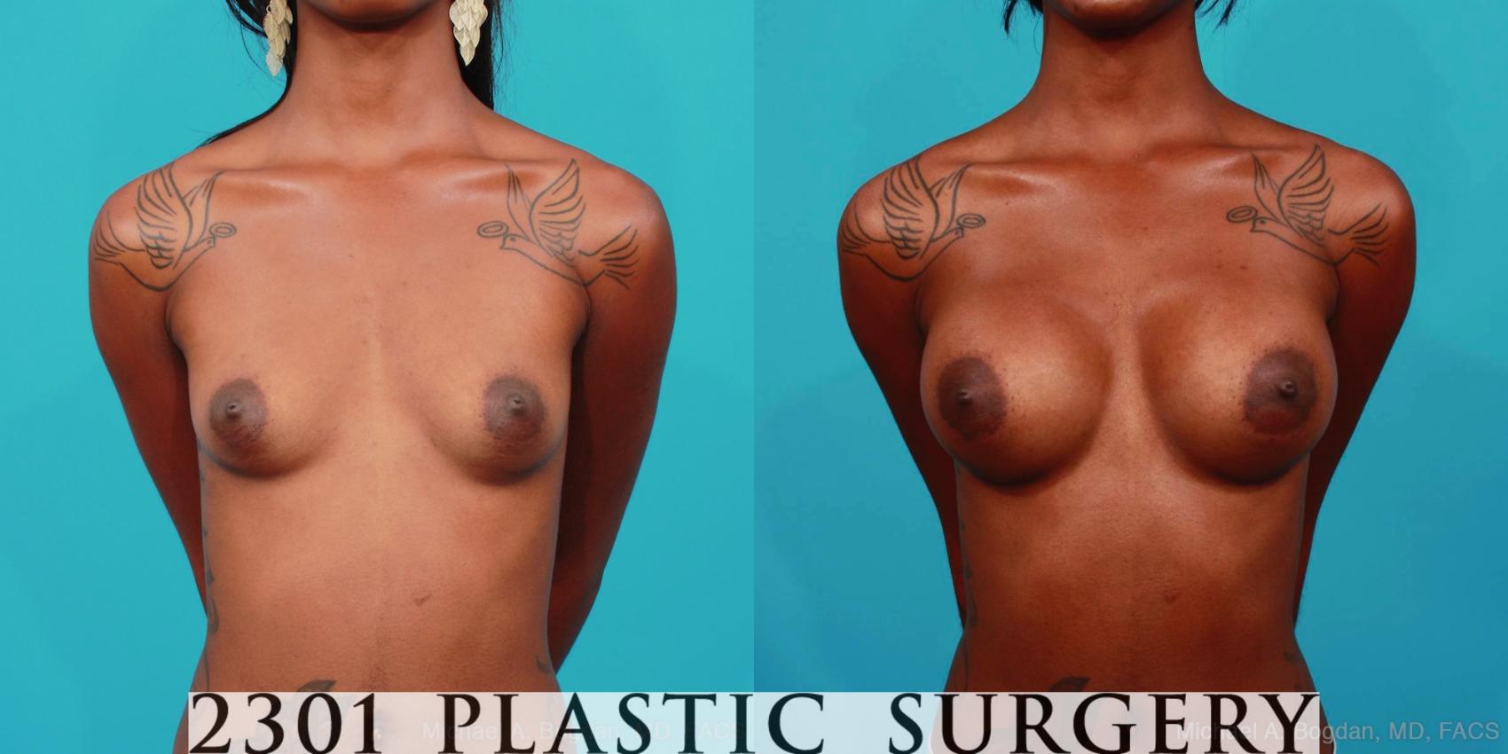 Before & After Silicone Implants Case 307 View #1 View in Fort Worth, Plano, & Frisco, Texas