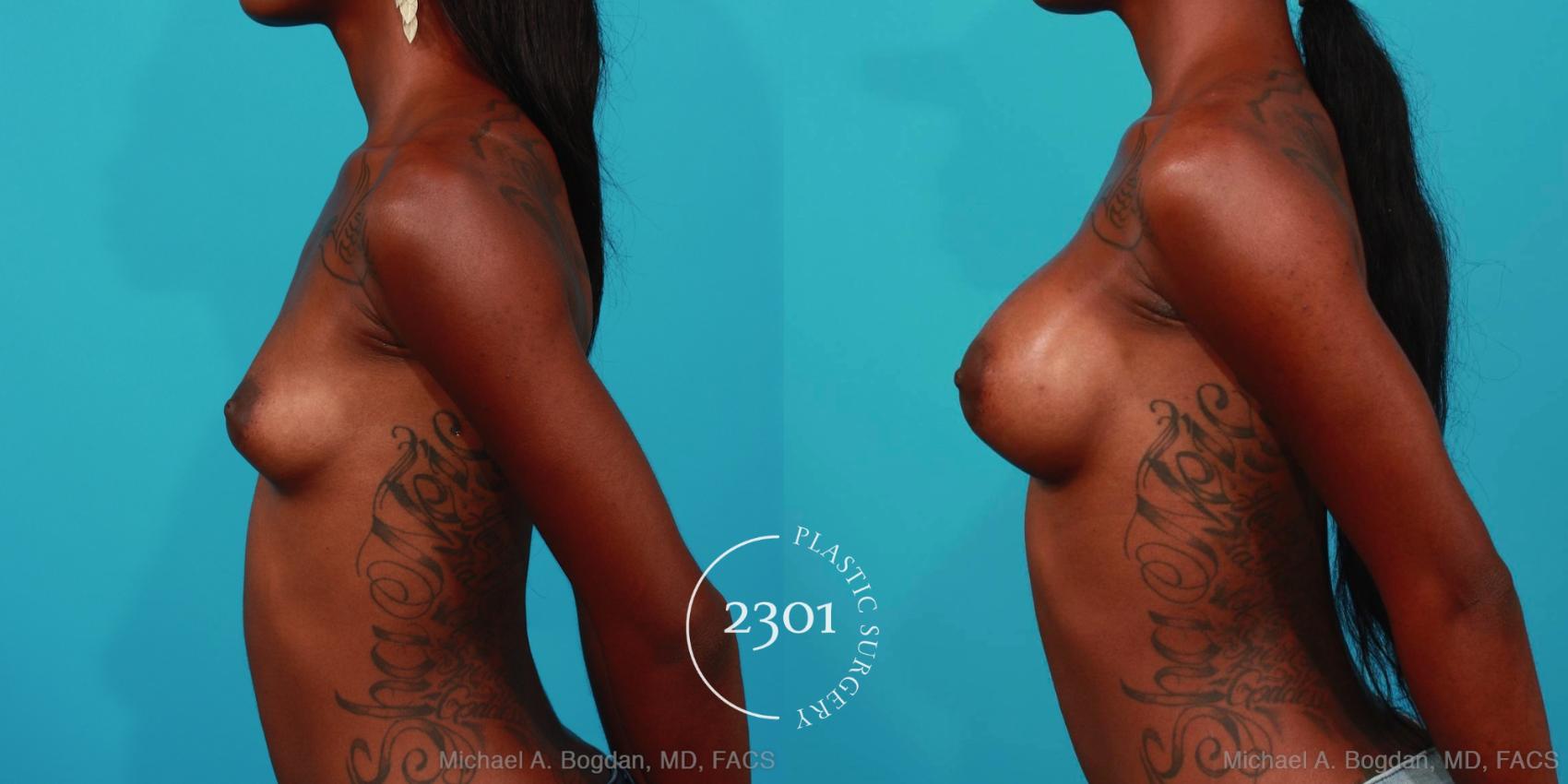 Before & After Breast Augmentation Case 307 View #2 View in Fort Worth, Plano, & Frisco, Texas