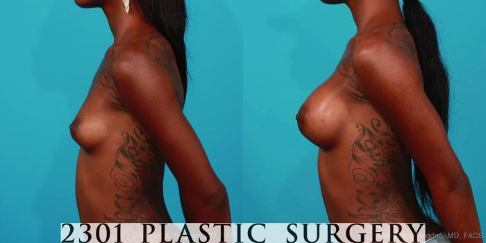 Before & After Silicone Implants Case 307 View #2 View in Fort Worth, Plano, & Frisco, Texas