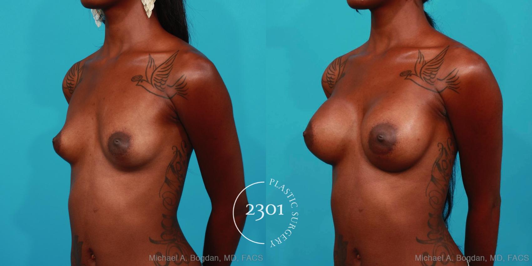 Before & After Breast Augmentation Case 307 View #3 View in Fort Worth, Plano, & Frisco, Texas