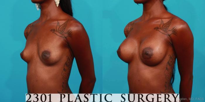 Before & After Silicone Implants Case 307 View #3 View in Fort Worth, Plano, & Frisco, Texas