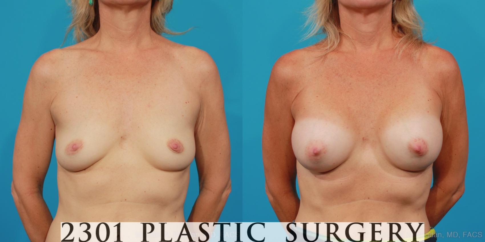 Before & After Breast Augmentation Case 309 View #1 View in Fort Worth, Plano, & Frisco, Texas