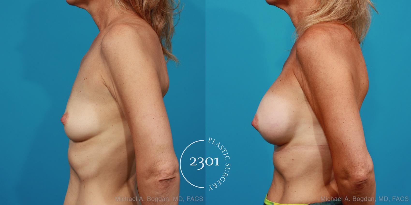 Before & After Silicone Implants Case 309 View #2 View in Fort Worth, Plano, & Frisco, Texas