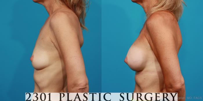 Before & After Breast Augmentation Case 309 View #2 View in Fort Worth, Plano, & Frisco, Texas