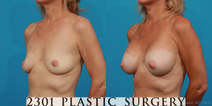 Before & After Breast Augmentation Case 309 View #3 View in Fort Worth, Plano, & Frisco, Texas