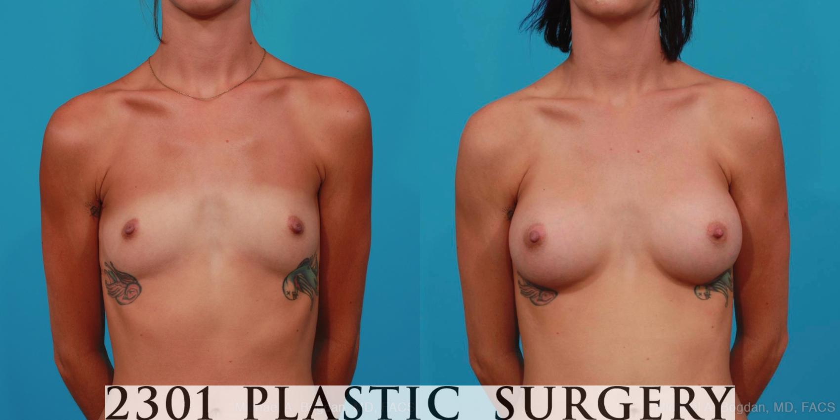 Before & After Breast Augmentation Case 310 View #1 View in Fort Worth, Plano, & Frisco, Texas