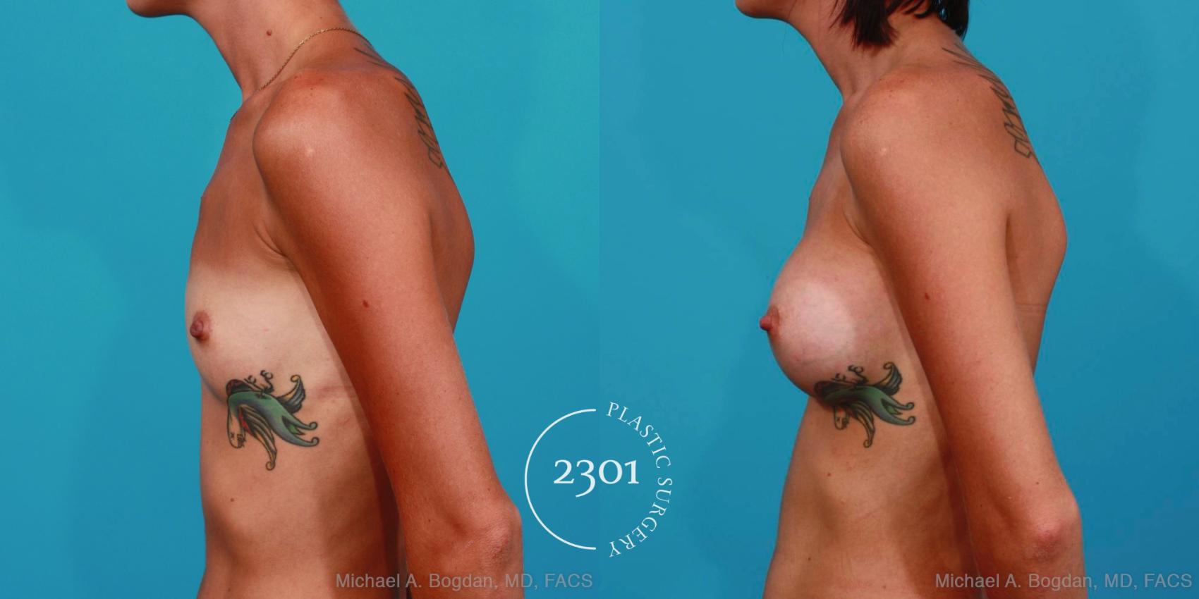 Before & After Silicone Implants Case 310 View #2 View in Fort Worth, Plano, & Frisco, Texas