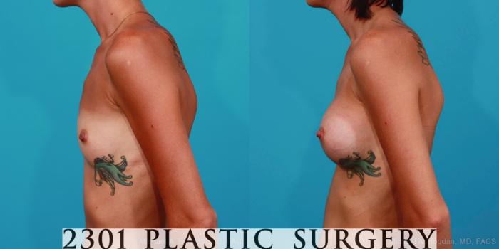 Before & After Breast Augmentation Case 310 View #2 View in Fort Worth, Plano, & Frisco, Texas