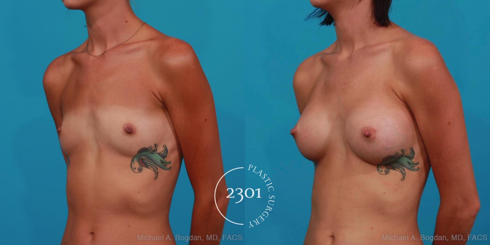 Before & After Silicone Implants Case 310 View #3 View in Fort Worth, Plano, & Frisco, Texas