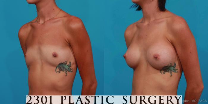 Before & After Silicone Implants Case 310 View #3 View in Fort Worth, Plano, & Frisco, Texas