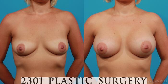 Before & After Silicone Implants Case 312 View #1 View in Fort Worth, Plano, & Frisco, Texas