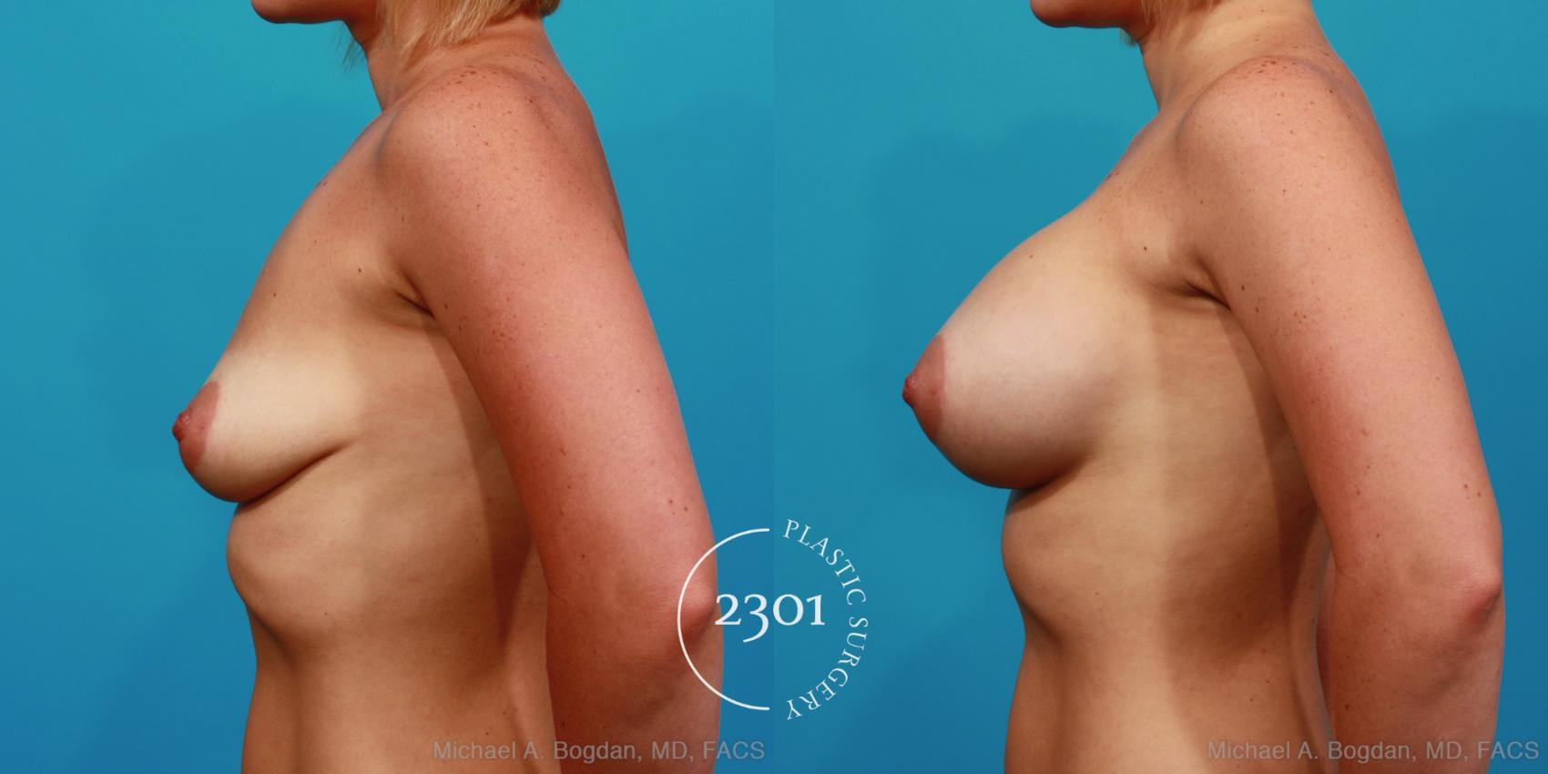 Before & After Silicone Implants Case 312 View #2 View in Fort Worth, Plano, & Frisco, Texas