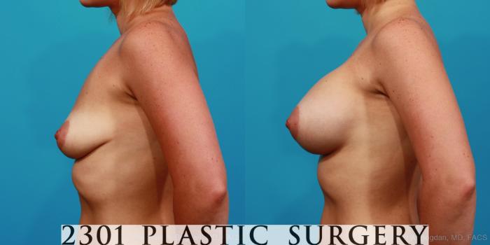 Before & After Breast Augmentation Case 312 View #2 View in Fort Worth, Plano, & Frisco, Texas