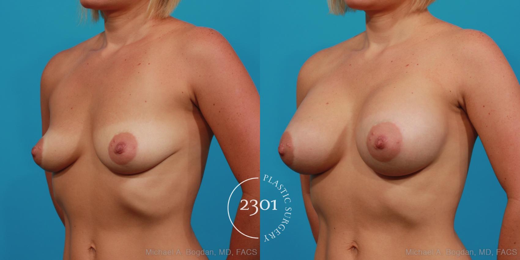 Before & After Silicone Implants Case 312 View #3 View in Fort Worth, Plano, & Frisco, Texas