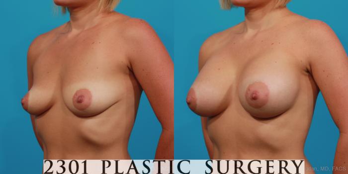 Before & After Breast Augmentation Case 312 View #3 View in Fort Worth, Plano, & Frisco, Texas